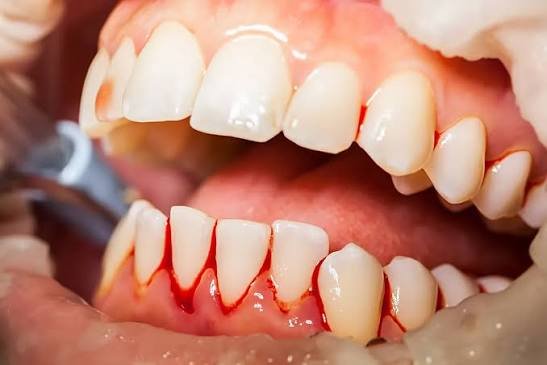 Bleeding gums showing blood between teeth during brushing