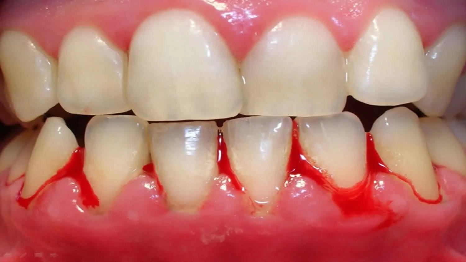 Dental examination showing inflamed bleeding gums requiring professional treatment